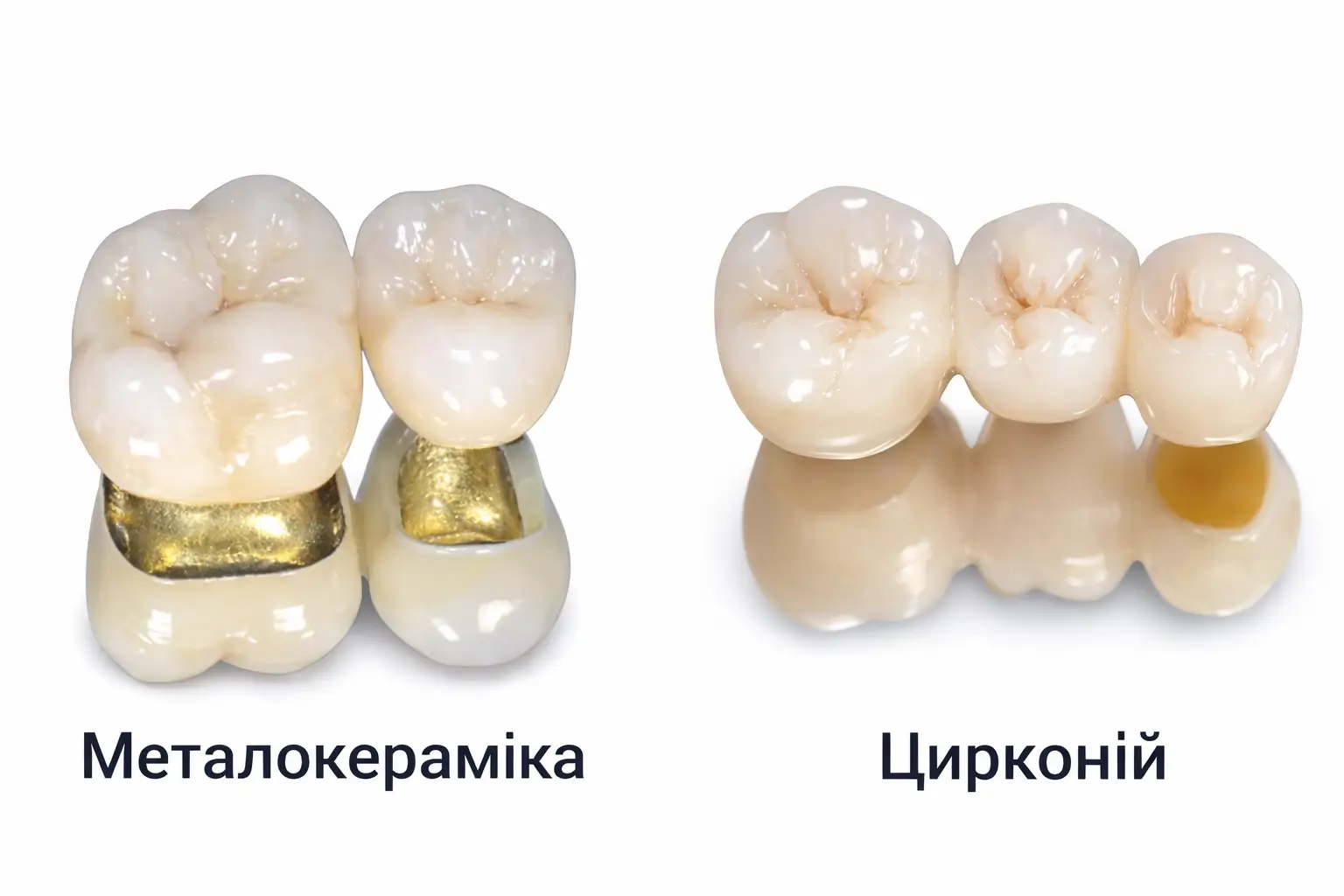 Металокераміка чи цирконій: що обирають пацієнти у 2026 році та чому